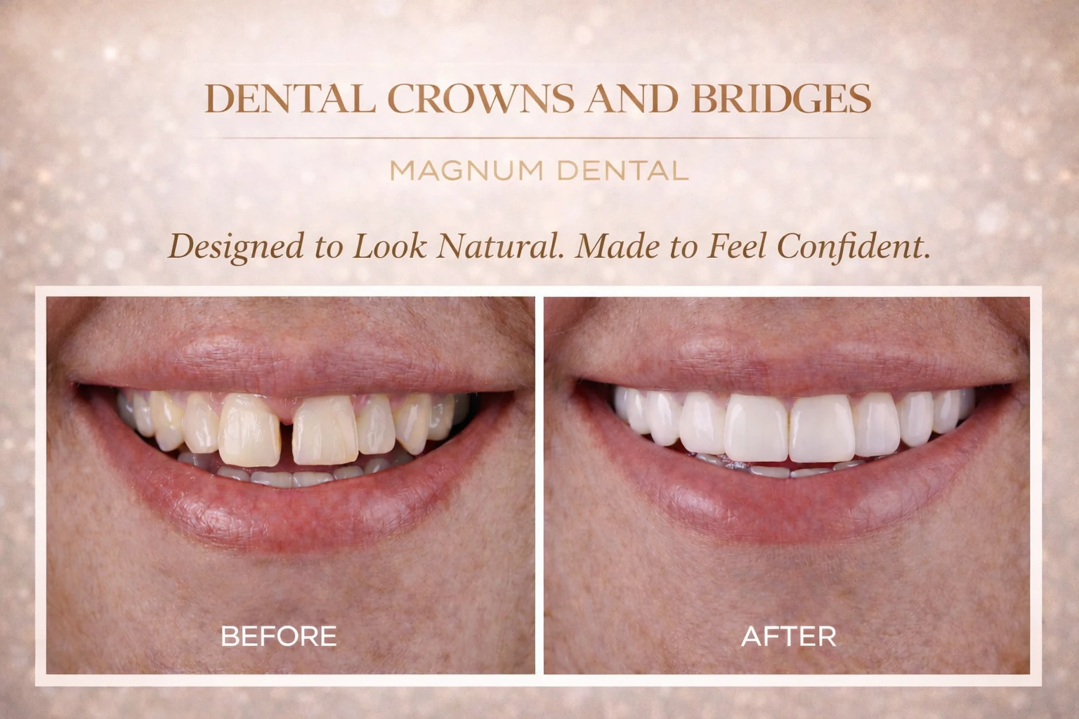 Dental crowns and bridges for restoring teeth
