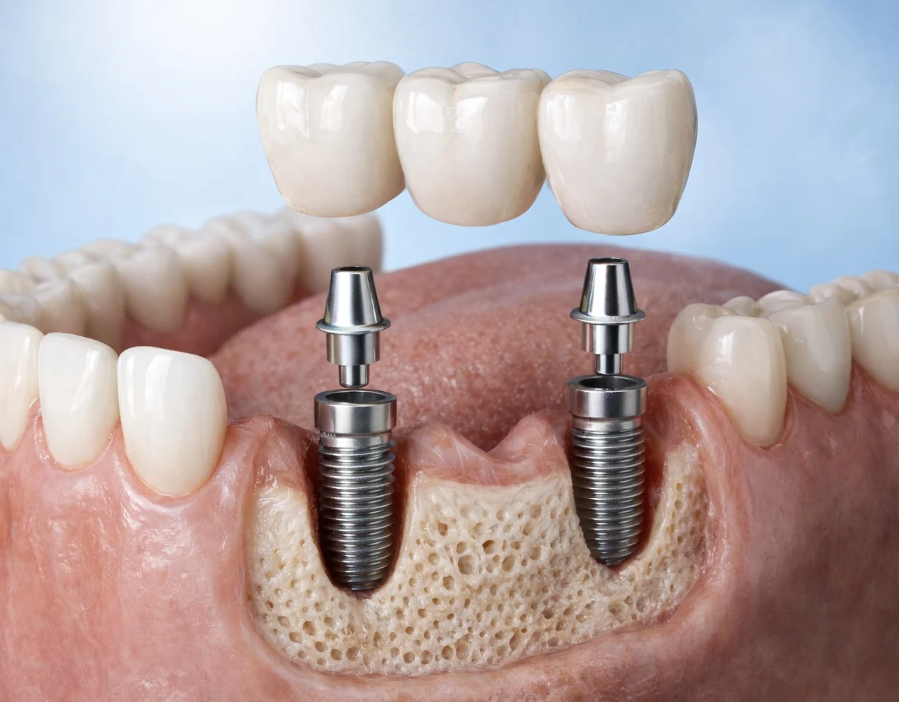 Dental Implants in Guwahati