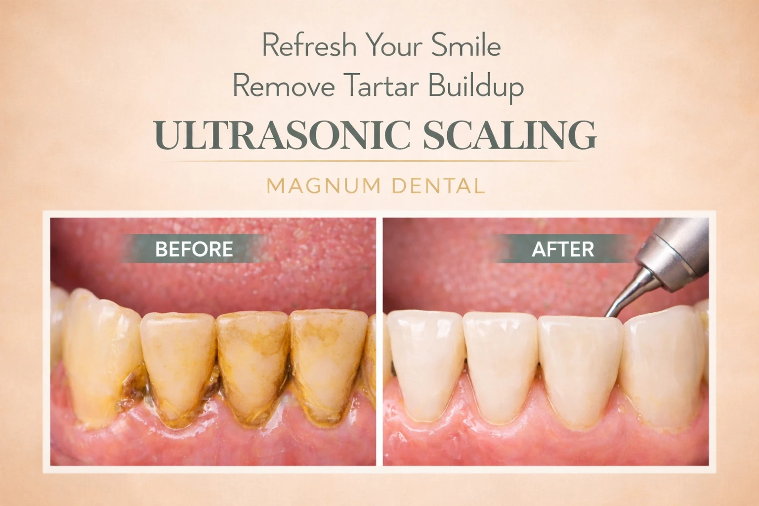 Ultrasonic scaling for professional teeth cleaning